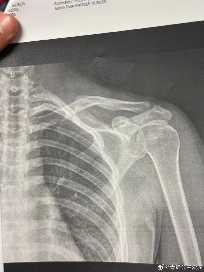 谷爱凌，锁骨受伤