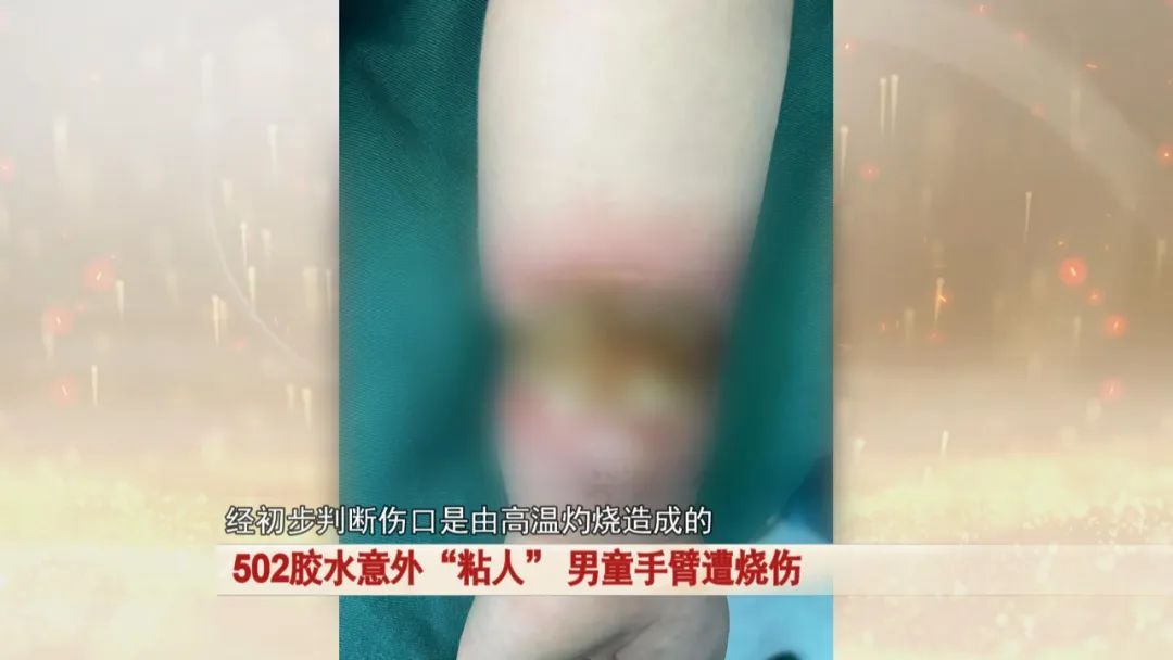 警惕！2岁幼童被502胶水“烧伤”