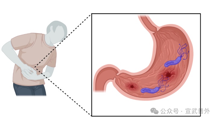 幽门螺杆菌阳性别慌！