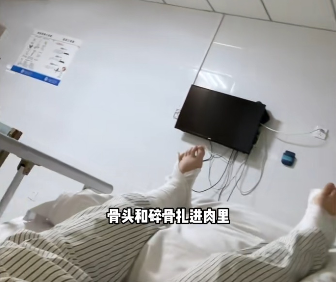 女网红腿部粉碎性骨折!打24个钉子,还要继续拼?网友紧急提醒 女网红腿部粉碎性骨折!打24个钉子,还要继续拼?网友紧急提醒