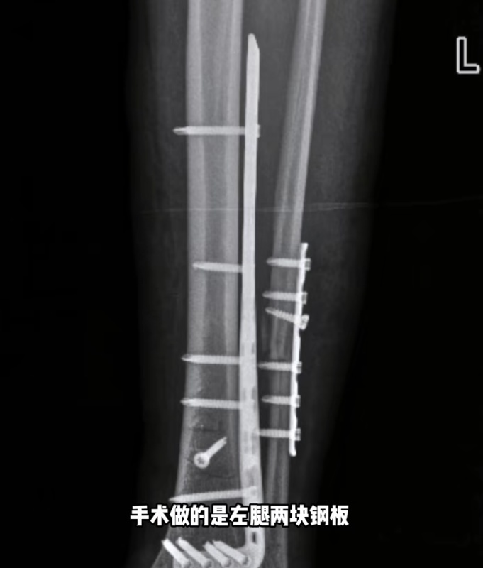 女网红腿部粉碎性骨折!打24个钉子,还要继续拼?网友紧急提醒 女网红腿部粉碎性骨折!打24个钉子,还要继续拼?网友紧急提醒