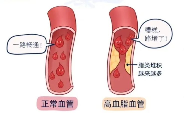 不吃肉就能降血脂吗？真相是……