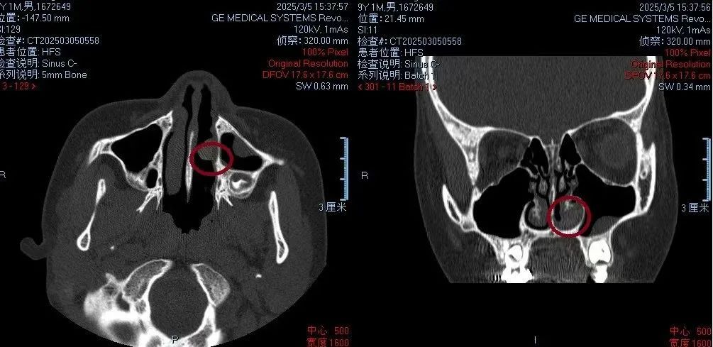 流涕、鼻塞久治不愈，竟是因为鼻腔里有一块“藏”了一年的橡皮！