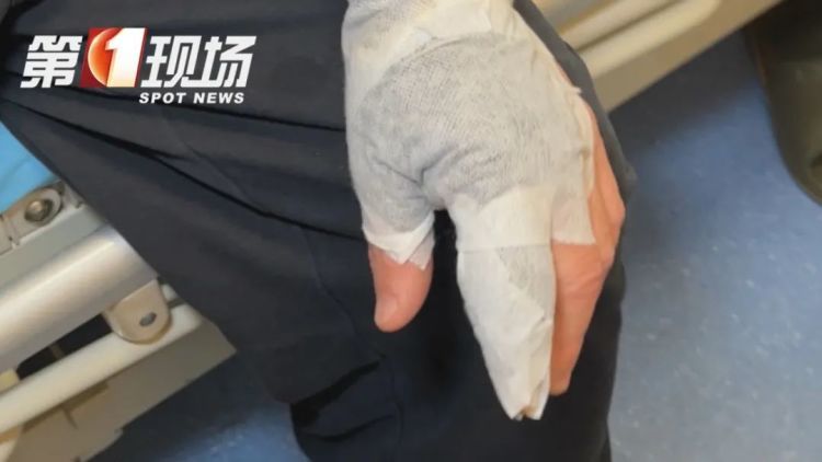 广东男子一个动作,“手肿成几倍大”,提醒:处理海鲜时最好戴上手套 广东男子一个动作,“手肿成几倍大”,提醒:处理海鲜时最好戴上手套