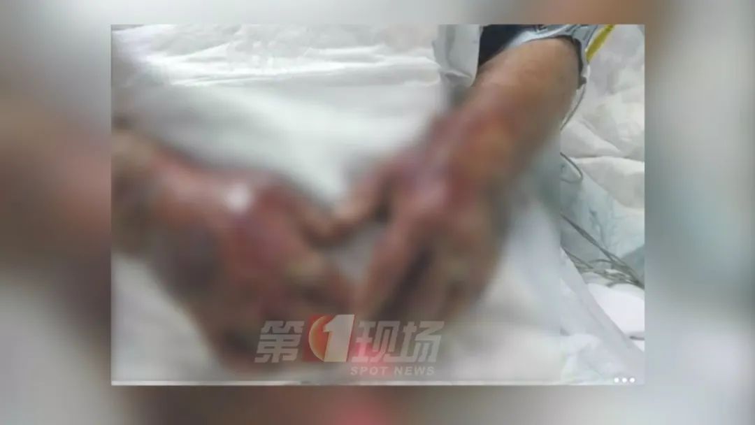处理海鲜戴手套!感染这种细菌致死率或达100% 处理海鲜戴手套!感染这种细菌致死率或达100%