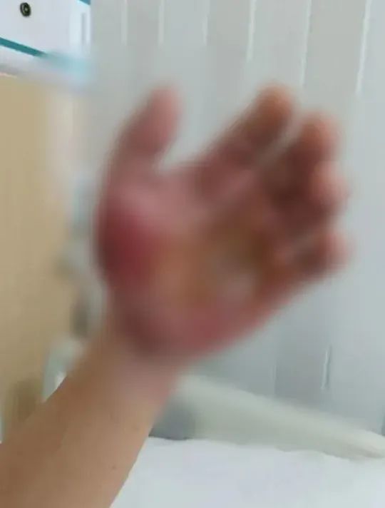 广东男子一个动作,“手肿成几倍大”,提醒:处理海鲜时最好戴上手套 广东男子一个动作,“手肿成几倍大”,提醒:处理海鲜时最好戴上手套