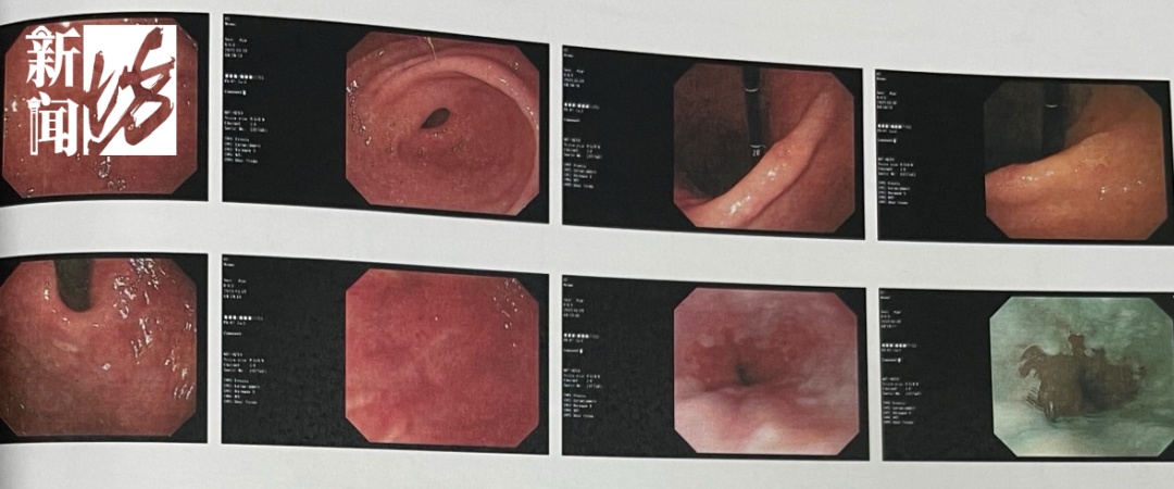 正大量上市! 上海多人紧急送医,近期高发! 有人呕血便血,还有人…紧急提醒