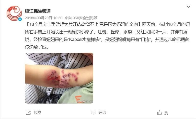 两岁宝宝因大人一个吻失明！眼角膜出现4毫米的穿孔，这种病毒屡见不鲜……