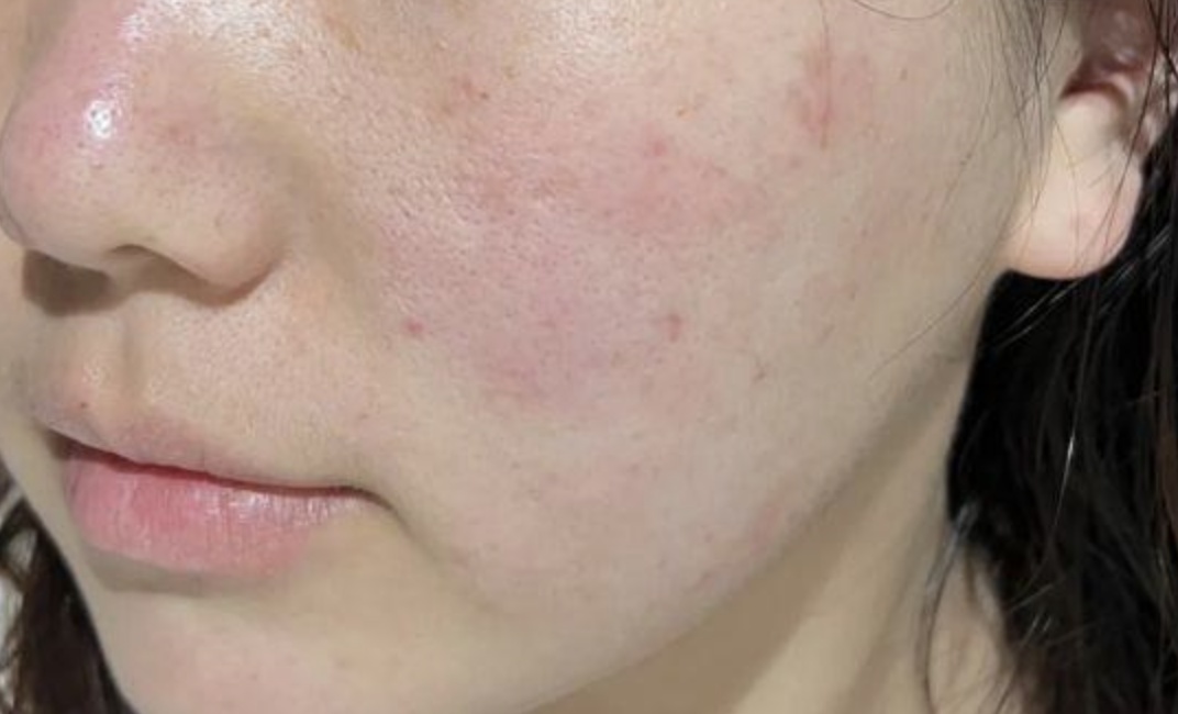 @过敏星人，花粉高峰期已至，防护指南——