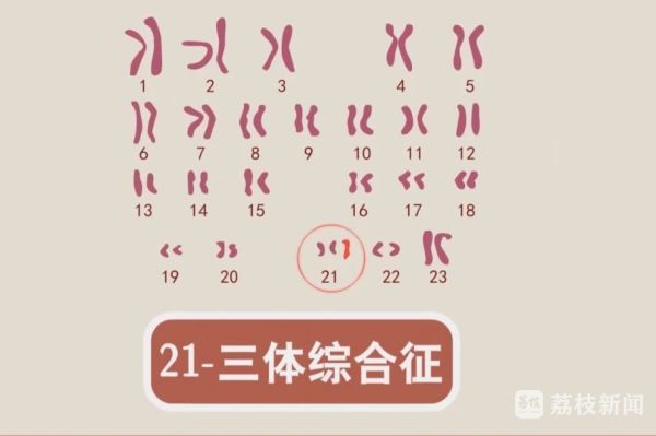 世界唐氏综合征日：关注“唐宝宝”