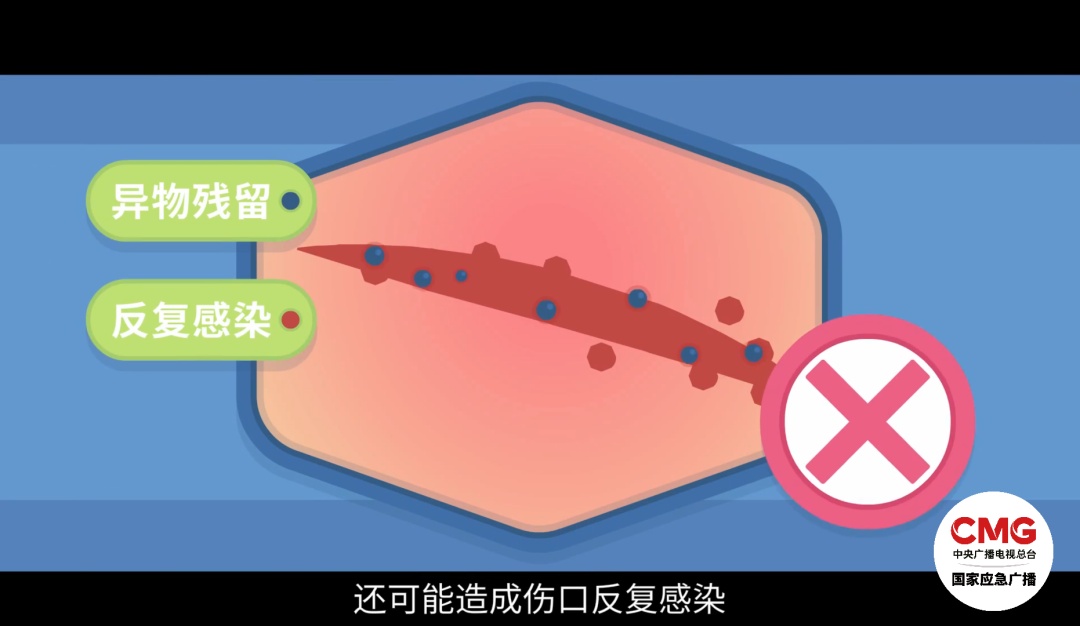 洗澡时它突然“自爆”，女子手筋断裂多处割伤！注意家里这个“隐形炸弹”→