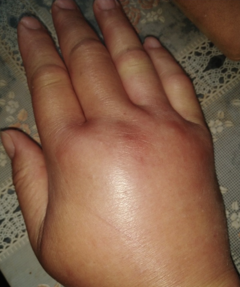 老婆被蜜蜂蜇伤!次日报警人求助“蓝朋友”排隐患 老婆被蜜蜂蜇伤!次日报警人求助“蓝朋友”排隐患