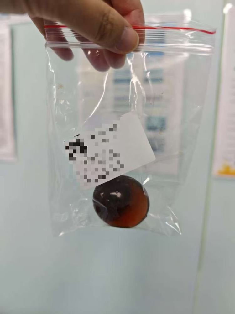 遇水就膨胀,2岁男孩误吞“水精灵”堵塞肠道被送医抢救 遇水就膨胀,2岁男孩误吞“水精灵”堵塞肠道被送医抢救