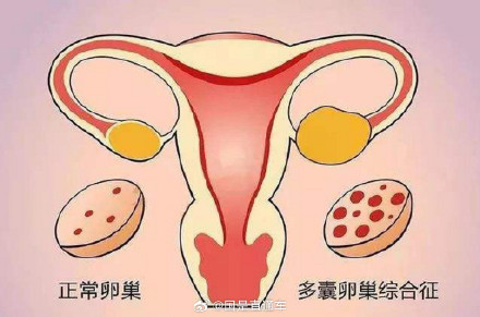 什么是多囊卵巢综合征？多囊卵巢综合征有哪些症状？