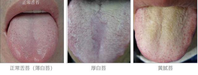 舌苔厚跟舌苔薄的人,到底谁更健康?结果竟然是…… 舌苔厚跟舌苔薄的人,到底谁更健康?结果竟然是……