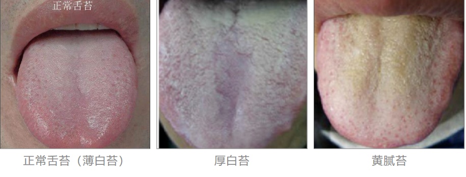 舌苔厚跟舌苔薄的人 到底谁更健康？