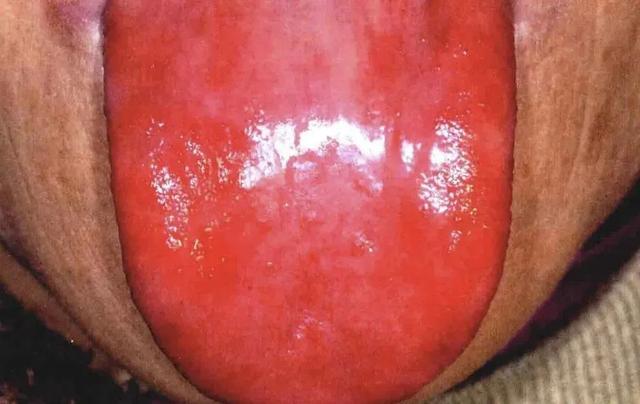 舌苔厚跟舌苔薄的人,到底谁更健康?结果竟然是…… 舌苔厚跟舌苔薄的人,到底谁更健康?结果竟然是……