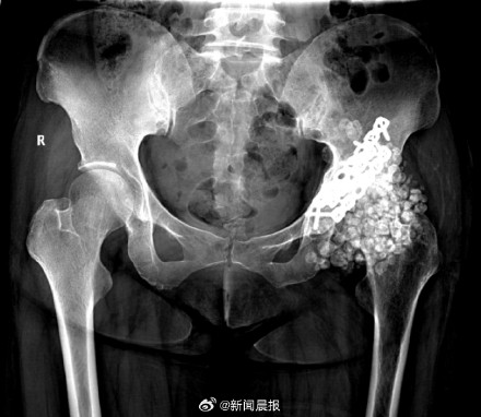 密恐慎入！女子关节取出300颗软骨瘤