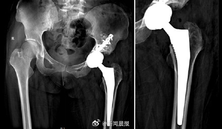 密恐慎入！女子关节取出300颗软骨瘤