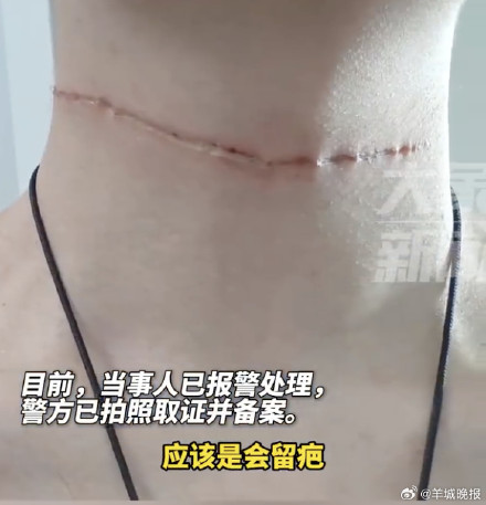 必须注意!2天3起风筝线危害行人事件 必须注意!2天3起风筝线危害行人事件