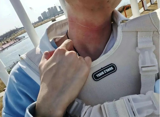 骑车遭“割喉”，缝了21针！近期多人遭殃！