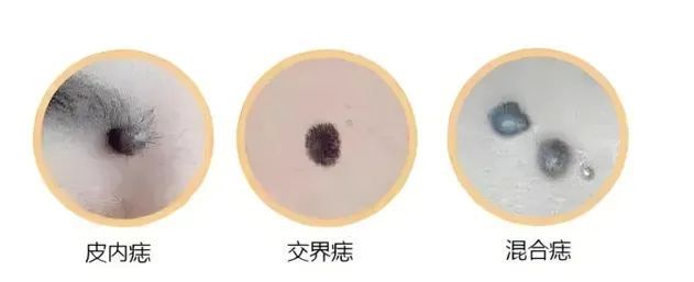 这几个地方长“痣”，一定要当心！