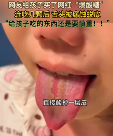 舌头酸脱皮！这款网红糖正在偷走孩子的味蕾，慎食