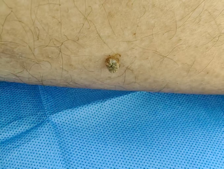 蜱虫又又又来了！别硬拔，已有人中招