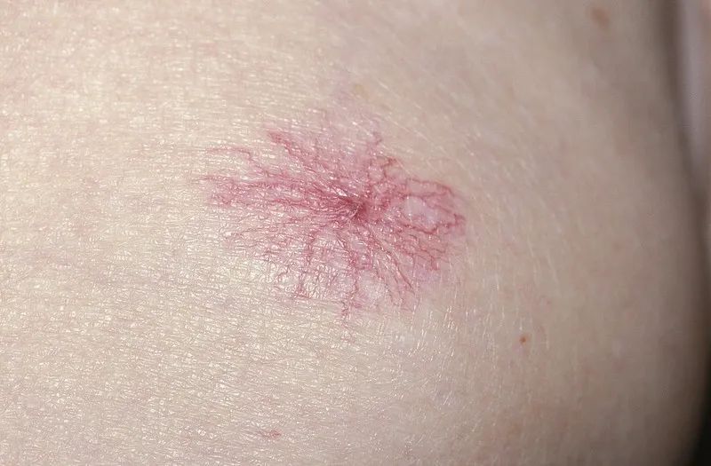 男子身上瘙痒,误以为过敏,一查竟是癌症! 男子身上瘙痒,误以为过敏,一查竟是癌症!