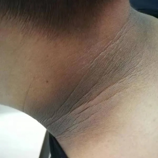 脖子“洗不干净”,或是身体发出危险信号 脖子“洗不干净”,或是身体发出危险信号