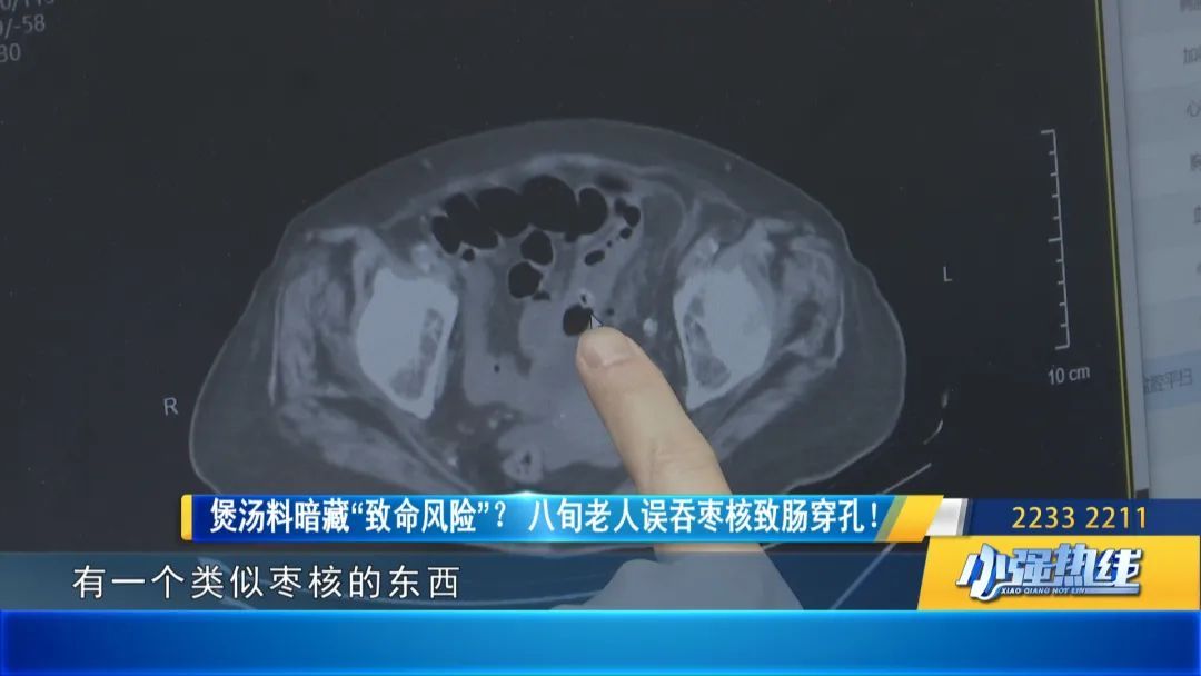 这种煲汤料,竟暗藏“致命风险”? 八旬老人不慎肠穿孔! 这种煲汤料,竟暗藏“致命风险”? 八旬老人不慎肠穿孔!