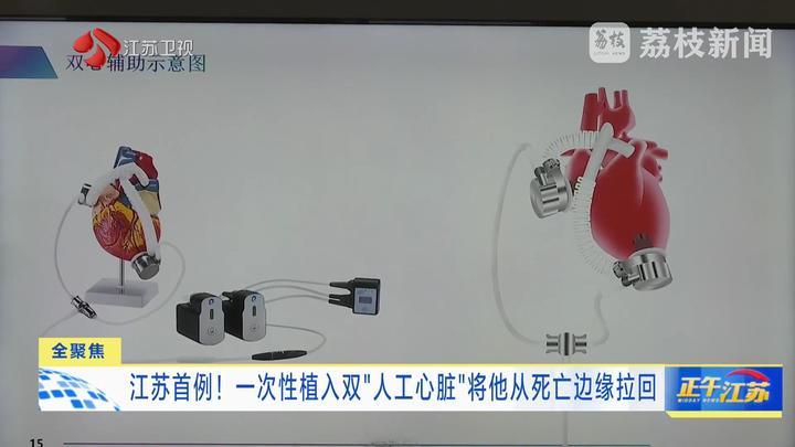 江苏首例！一次性植入双“人工心脏”将他从死亡边缘拉回