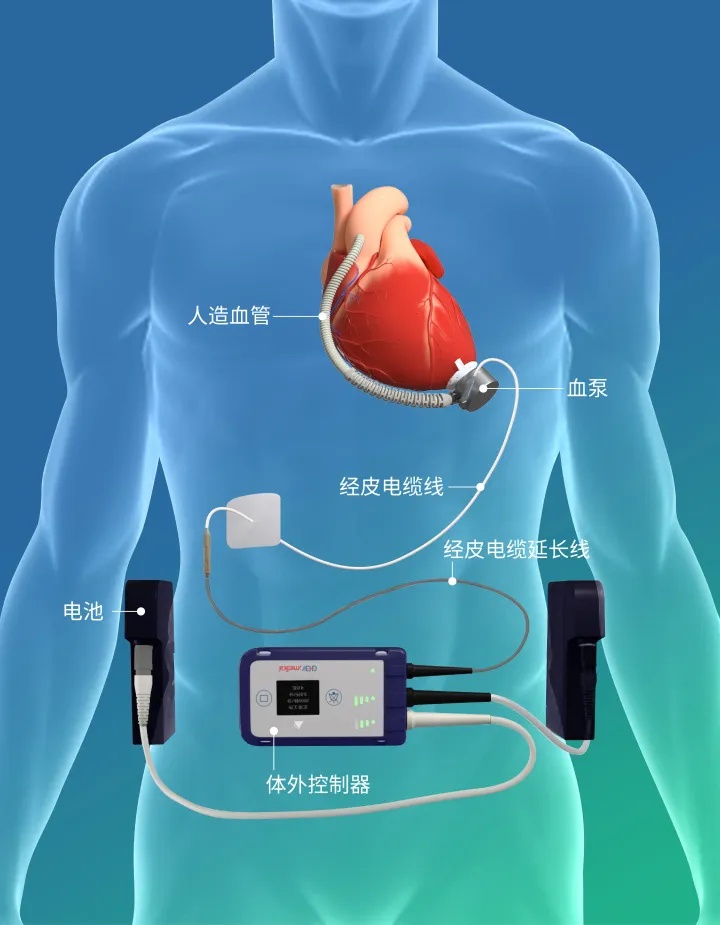 他植入两颗心，一颗是人工的，另一颗也是