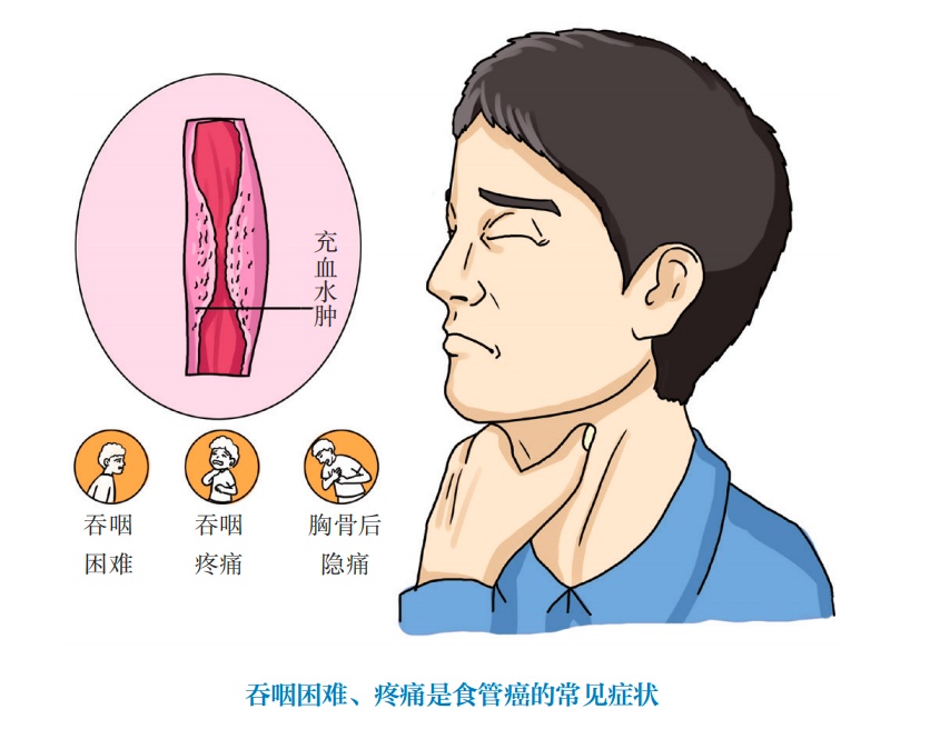 夫妻双双确诊同一种癌，有这个习惯的赶紧改！