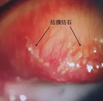 女子双眼干痒总流泪，医生在她眼里揪出十几颗“石头”……
