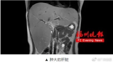 女生深陷抑郁症幕后真凶是罕见病