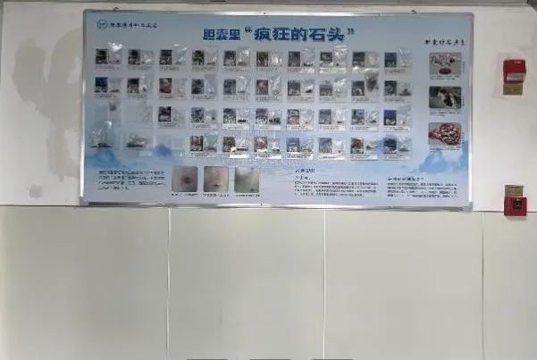 26岁，体内藏了上百颗“石头”？医生：这件事，很多人还在做