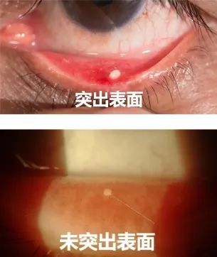 女子双眼干痒总流泪，医生在她眼里揪出十几颗“石头”……