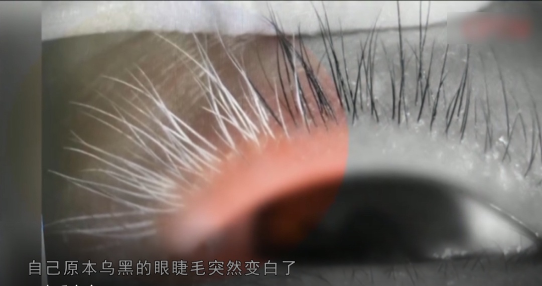 可怕！女子睫毛突然变白，一查睫毛上竟有……