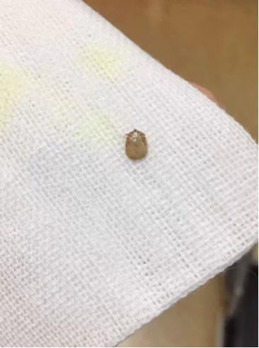 浙江男子出了一趟门，身上惊现“大痣”，严重可致死，最近高发……
