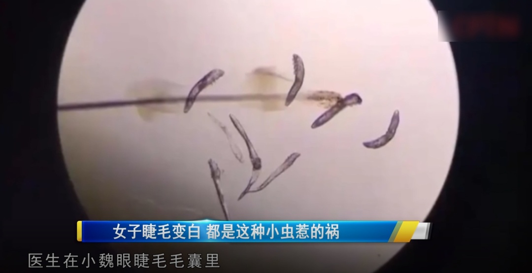 可怕！女子睫毛突然变白，一查睫毛上竟有……