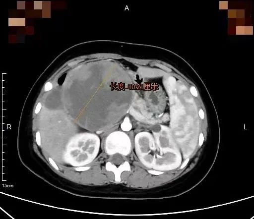少女一口气吃15个饺子，结果腹痛难忍，差点丢了命！一查竟是体内……