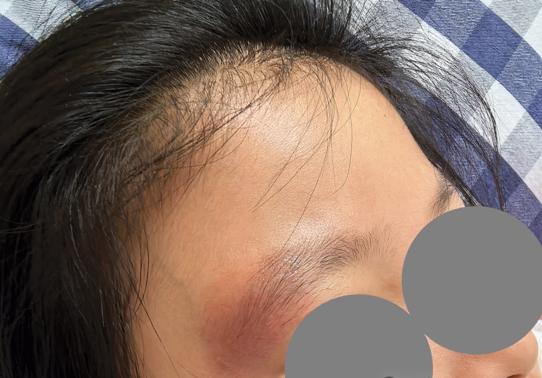 长“黑痣”？别“硬拔”，已有10岁小女孩中招！疾控部门：已进入高发季