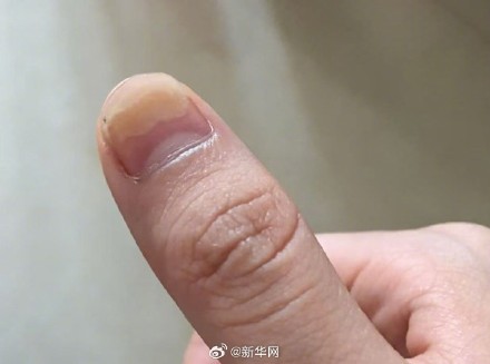 如何守护“指尖上的美丽”？