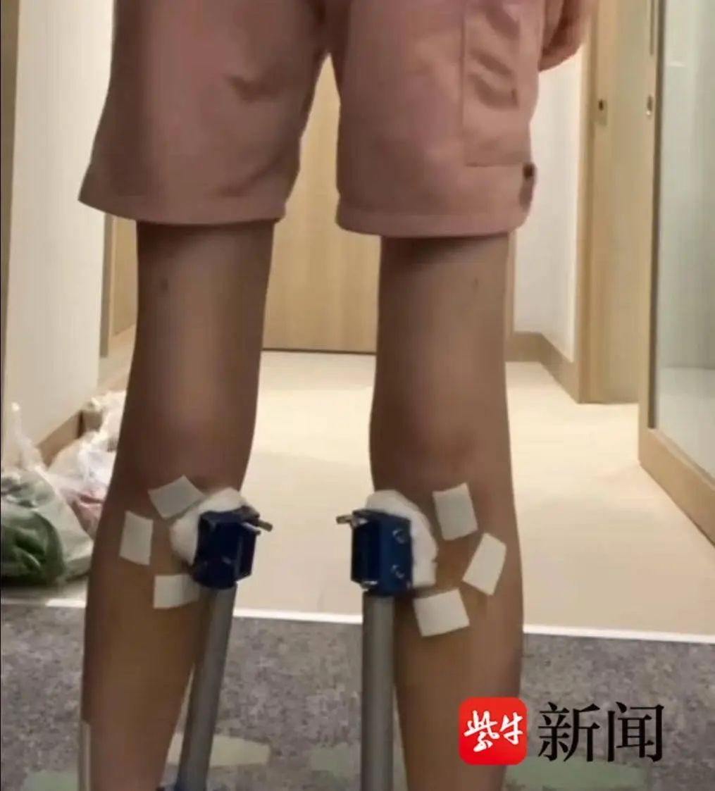 江苏女孩花60万去国外“断骨增高”13cm，后怕的事发生了：像有颗定时炸弹藏在身体里