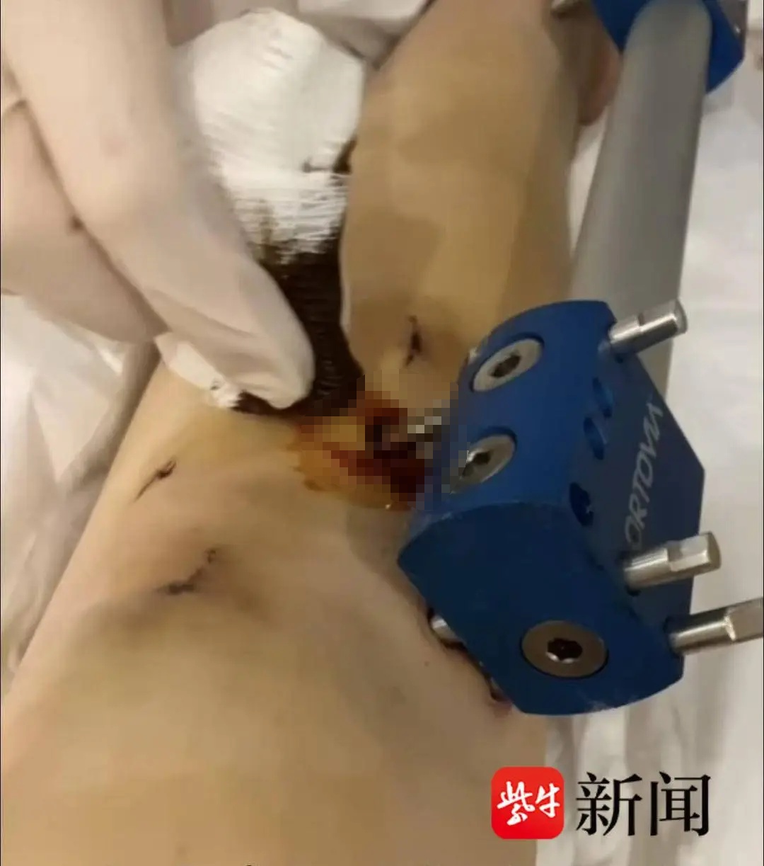 女子花60万断骨增高！好腿变X型腿，每天打止痛针
