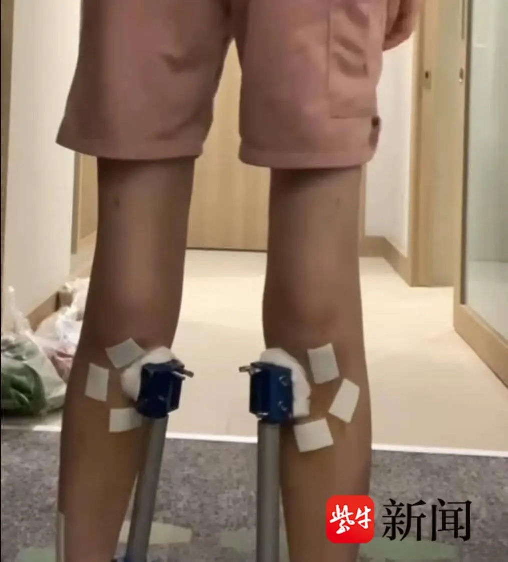 女子花60万断骨增高！好腿变X型腿，每天打止痛针
