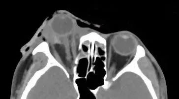 好险!男子一跤摔出眼珠子 医生提醒→ 好险!男子一跤摔出眼珠子 医生提醒→