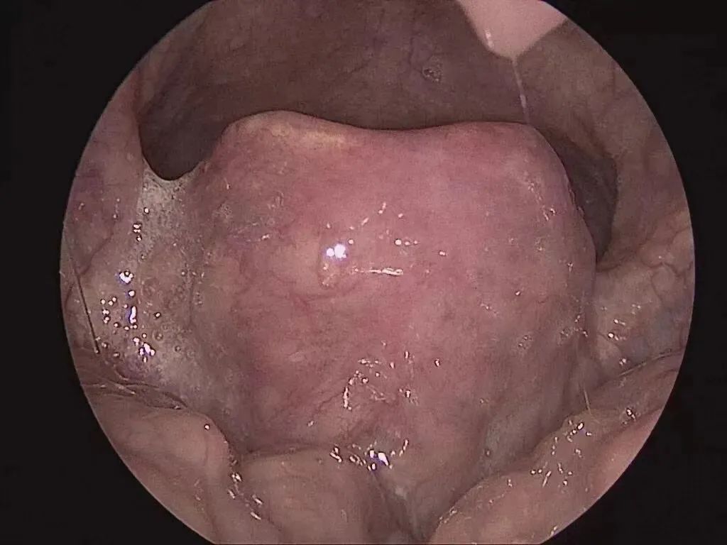 郑州一女子从就诊到去世仅10分钟！这种病千万别认为是上火！