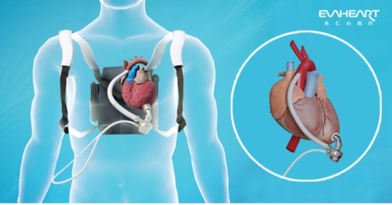 福建首个植入人工心脏的人，把人工心关了……